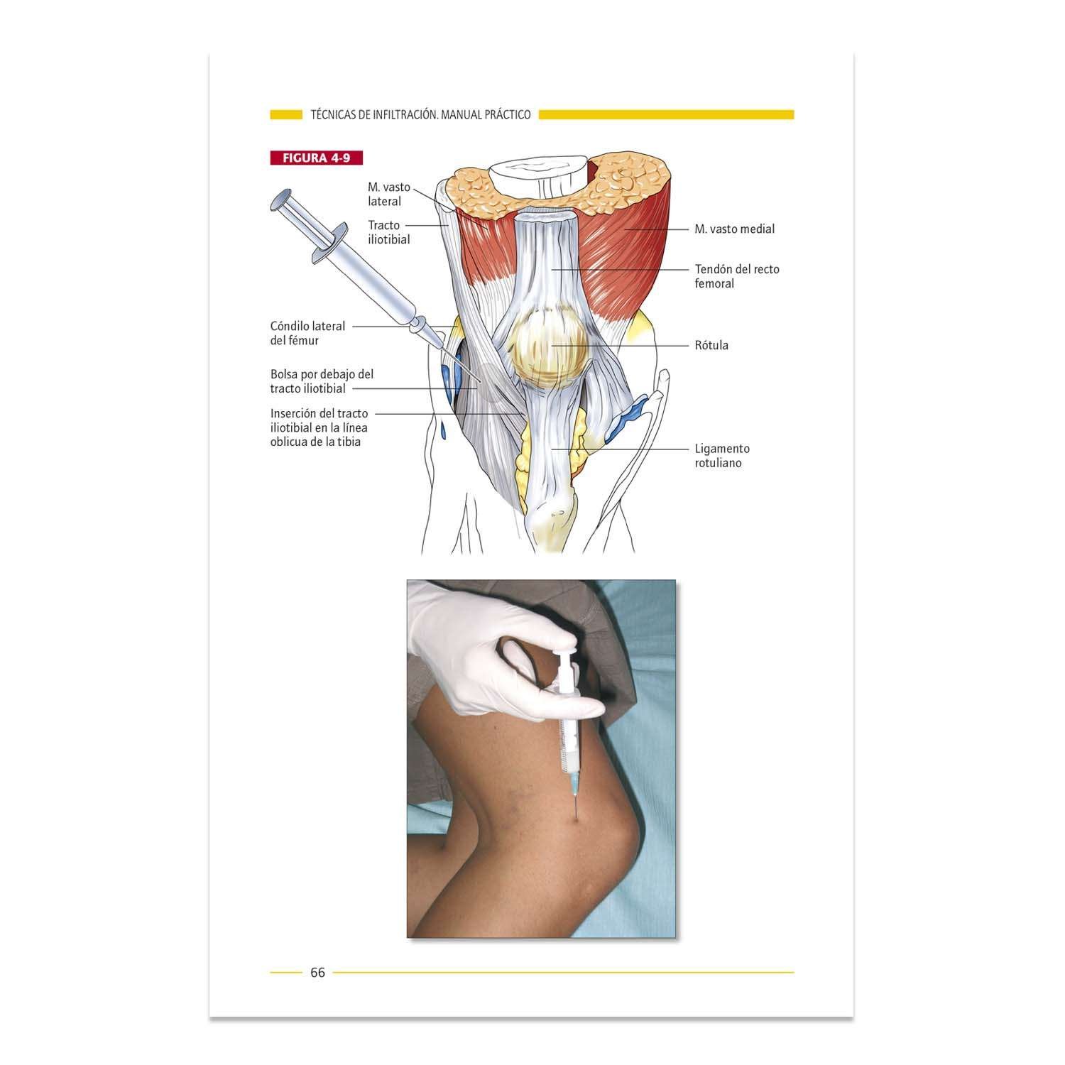 Técnicas de Infiltración Manual Práctico - Imagen 3