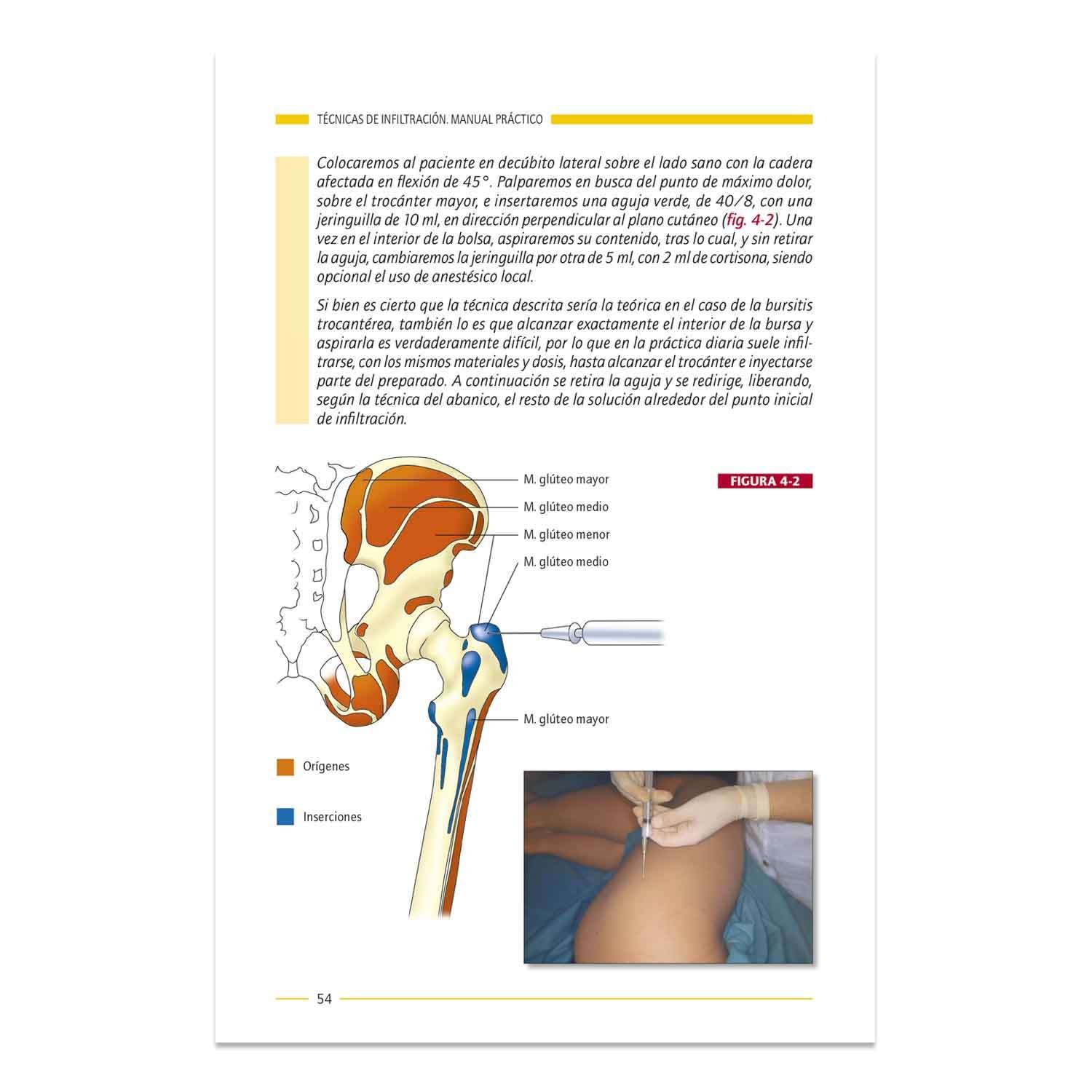 Técnicas de Infiltración Manual Práctico - Imagen 4